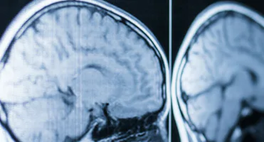 traumatic brain injury, TBI, injuries, post-traumatic, amnesia assessment, Glasgow Coma Score, brain scan, frontal lobes, brain