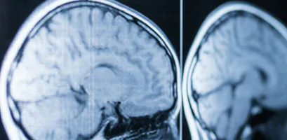 traumatic brain injury, TBI, injuries, post-traumatic, amnesia assessment, Glasgow Coma Score, brain scan, frontal lobes, brain